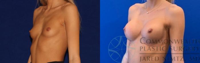 Before & After Breast Augmentation Case 140 Left Oblique View in Lexington & Lousiville, KY