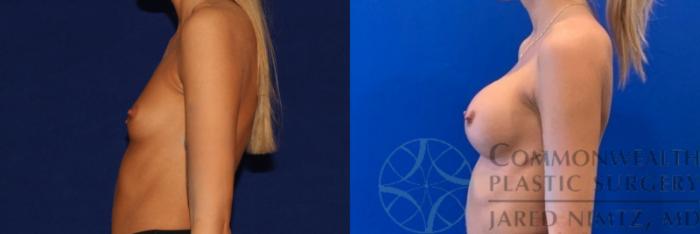 Before & After Breast Augmentation Case 140 Left Side View in Lexington & Lousiville, KY
