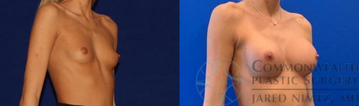 Before & After Breast Augmentation Case 140 Right Oblique View in Lexington & Lousiville, KY