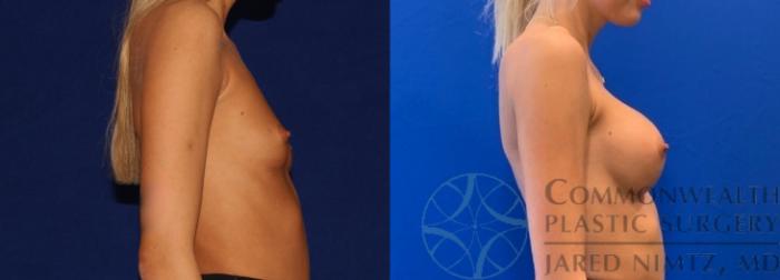 Before & After Breast Augmentation Case 140 Right Side View in Lexington & Lousiville, KY