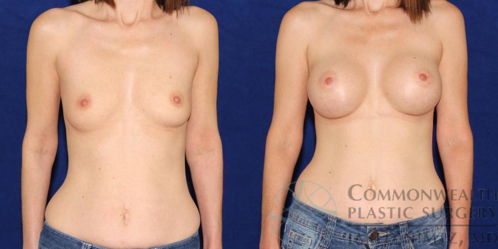 Before & After Breast Augmentation Case 41 View #1 View in Lexington & London, KY