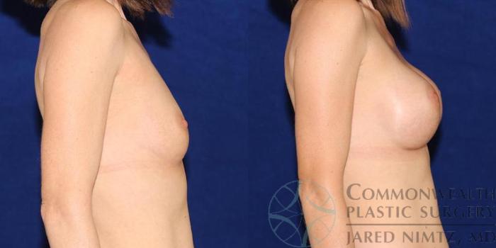 Before & After Breast Augmentation Case 41 View #5 View in Lexington & London, KY