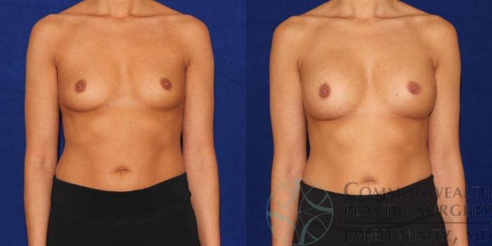 Before & After Breast Augmentation Case 42 View #1 View in Lexington & London, KY
