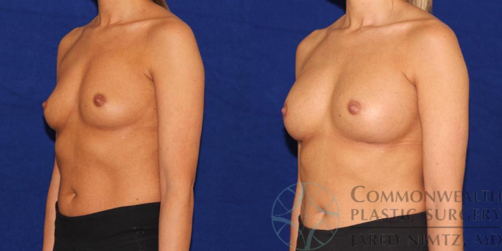 Before & After Breast Augmentation Case 42 View #2 View in Lexington & Lousiville, KY