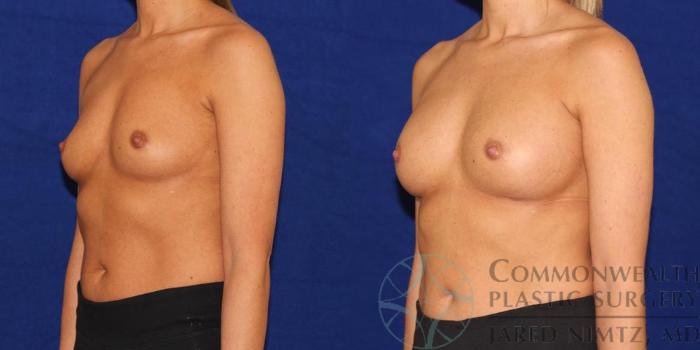 Before & After Breast Augmentation Case 42 View #2 View in Lexington & London, KY
