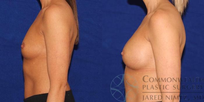 Before & After Breast Augmentation Case 42 View #3 View in Lexington & London, KY