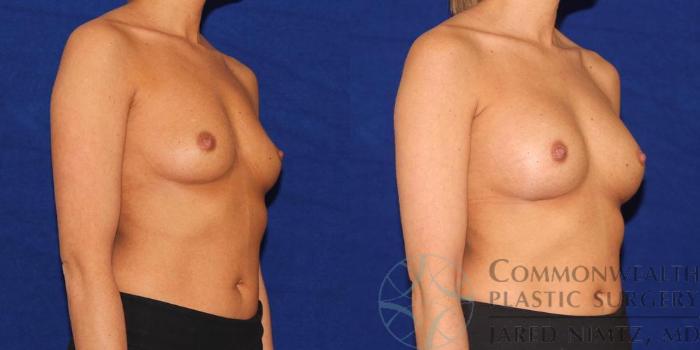 Before & After Breast Augmentation Case 42 View #4 View in Lexington & London, KY