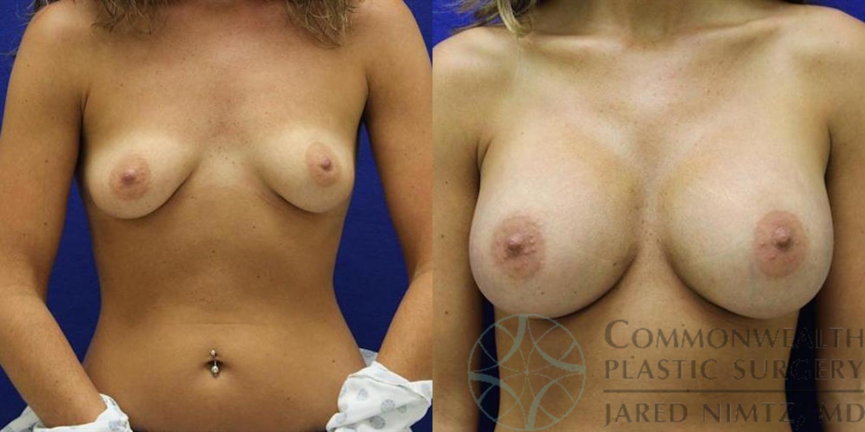 Before & After Breast Augmentation Case 43 View #1 View in Lexington & London, KY