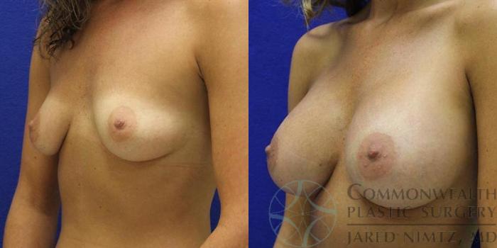 Before & After Breast Augmentation Case 43 View #2 View in Lexington & London, KY