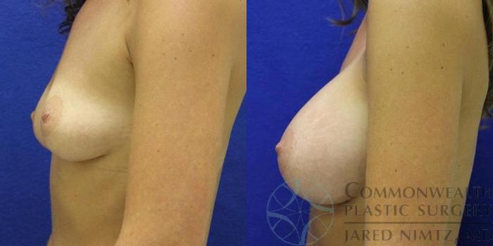 Before & After Breast Augmentation Case 43 View #3 View in Lexington & London, KY