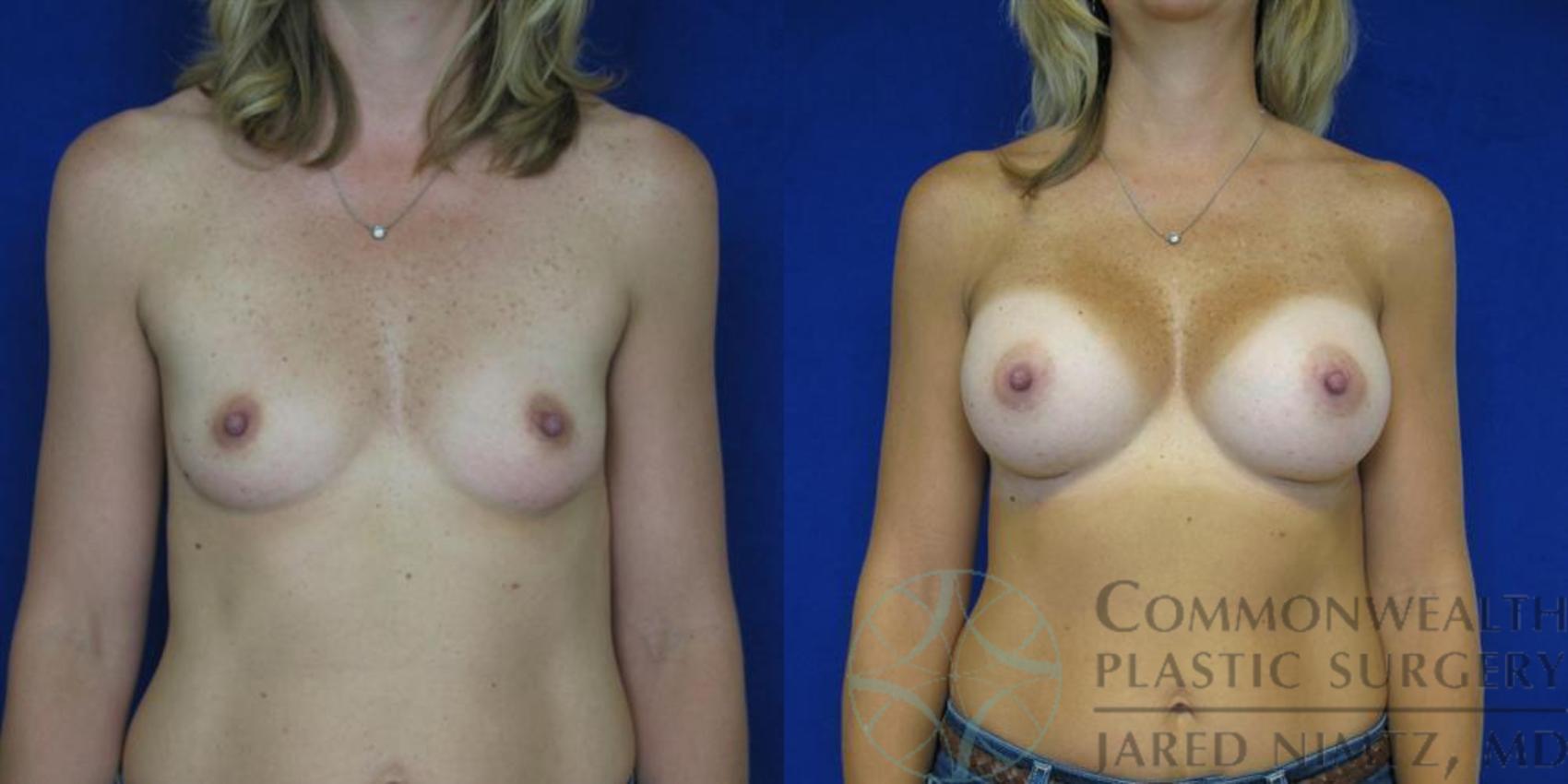 Before & After Breast Augmentation Case 44 View #1 View in Lexington & London, KY