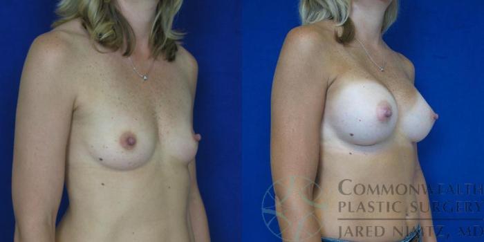 Before & After Breast Augmentation Case 44 View #2 View in Lexington & London, KY