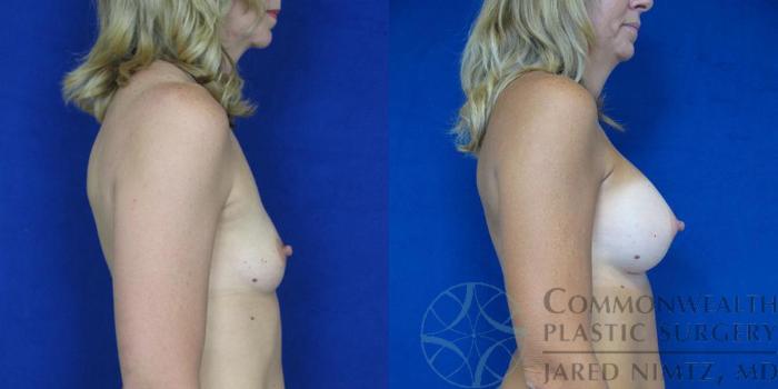 Before & After Breast Augmentation Case 44 View #3 View in Lexington & London, KY
