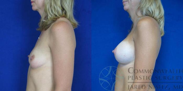 Before & After Breast Augmentation Case 44 View #5 View in Lexington & London, KY