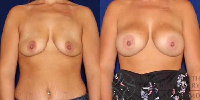 Before & After Breast Augmentation Case 45 View #1 View in Lexington & London, KY