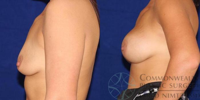 Before & After Breast Augmentation Case 45 View #4 View in Lexington & London, KY