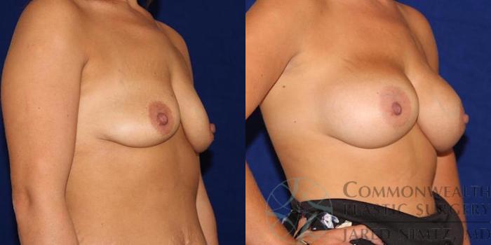 Before & After Breast Augmentation Case 45 View #5 View in Lexington & London, KY