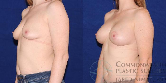 Before & After Breast Augmentation Case 46 View #2 View in Lexington & London, KY