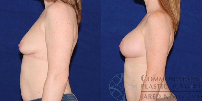 Before & After Breast Augmentation Case 46 View #3 View in Lexington & London, KY