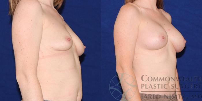 Before & After Breast Augmentation Case 46 View #4 View in Lexington & London, KY