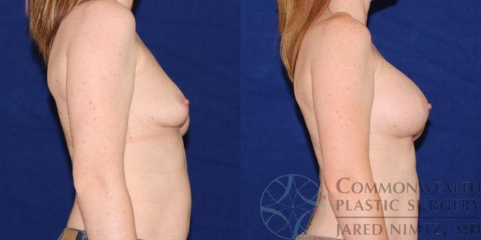Before & After Breast Augmentation Case 46 View #5 View in Lexington & London, KY