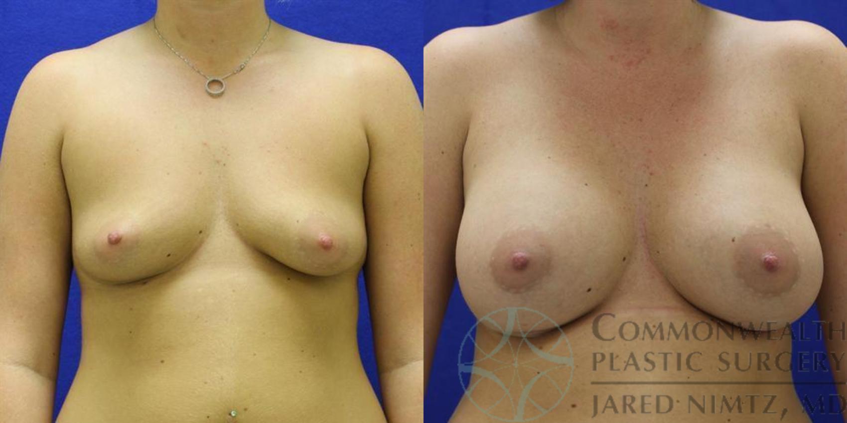 Before & After Breast Augmentation Case 47 View #1 View in Lexington & London, KY