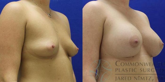 Before & After Breast Augmentation Case 47 View #2 View in Lexington & London, KY
