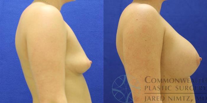 Before & After Breast Augmentation Case 47 View #3 View in Lexington & London, KY