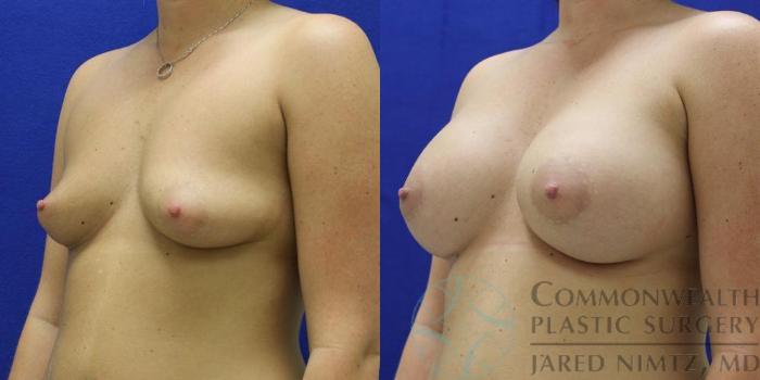 Before & After Breast Augmentation Case 47 View #4 View in Lexington & London, KY