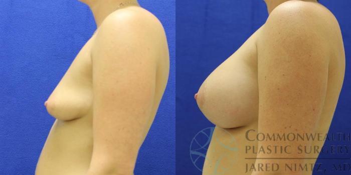 Before & After Breast Augmentation Case 47 View #5 View in Lexington & London, KY
