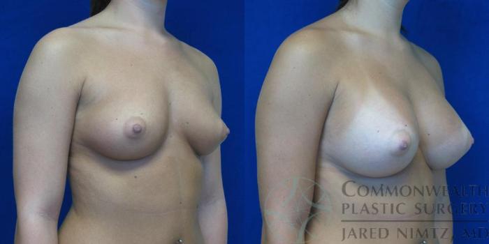 Before & After Breast Augmentation Case 48 View #2 View in Lexington & London, KY