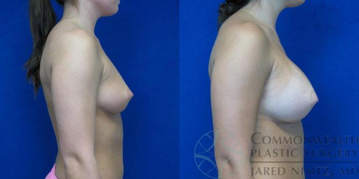 Before & After Breast Augmentation Case 48 View #3 View in Lexington & London, KY