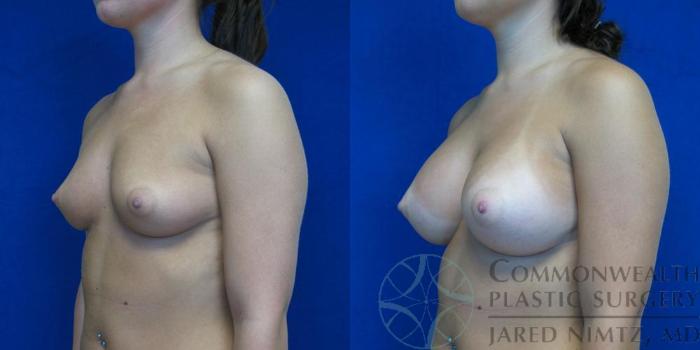 Before & After Breast Augmentation Case 48 View #4 View in Lexington & London, KY