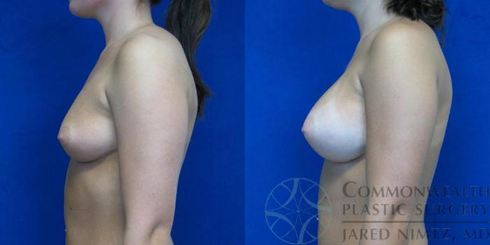 Before & After Breast Augmentation Case 48 View #5 View in Lexington & London, KY