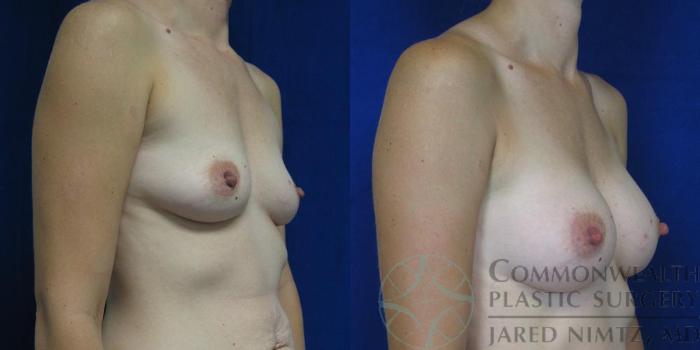Before & After Breast Augmentation Case 49 View #2 View in Lexington & London, KY