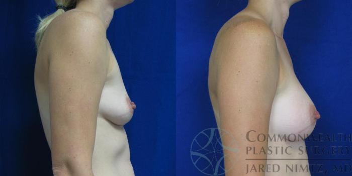 Before & After Breast Augmentation Case 49 View #3 View in Lexington & London, KY