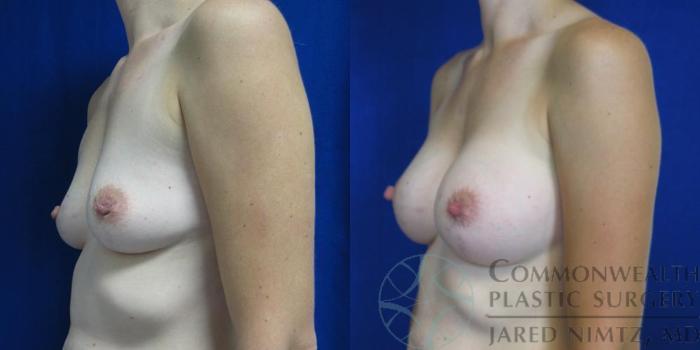 Before & After Breast Augmentation Case 49 View #4 View in Lexington & London, KY