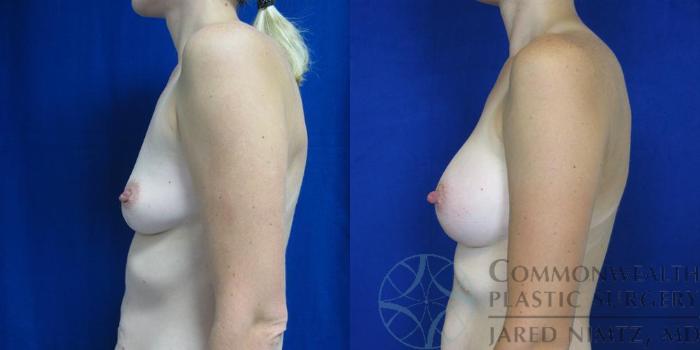 Before & After Breast Augmentation Case 49 View #5 View in Lexington & London, KY