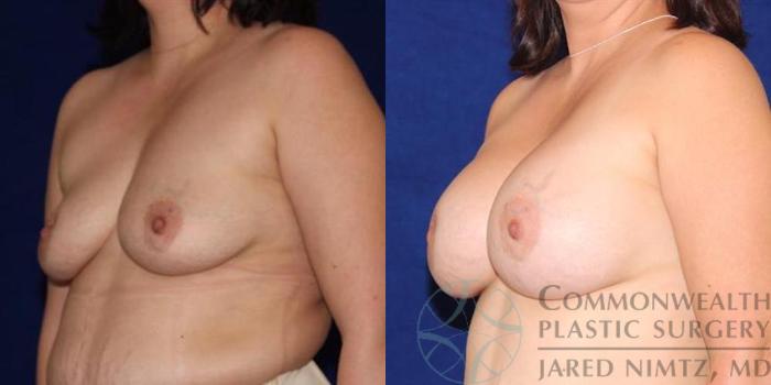 Before & After Breast Augmentation Case 50 View #2 View in Lexington & London, KY