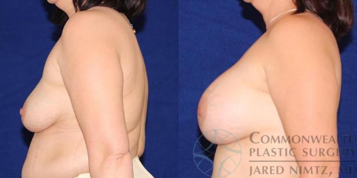 Before & After Breast Augmentation Case 50 View #3 View in Lexington & London, KY
