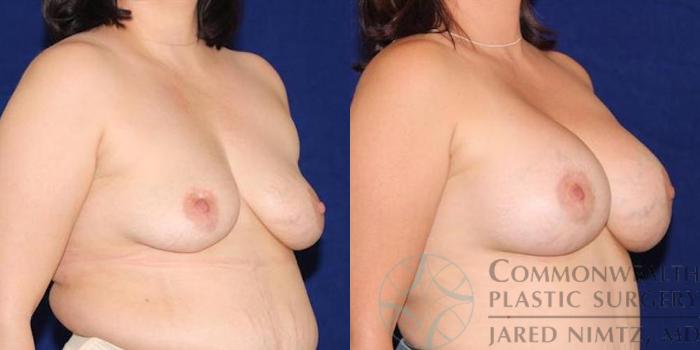 Before & After Breast Augmentation Case 50 View #4 View in Lexington & London, KY