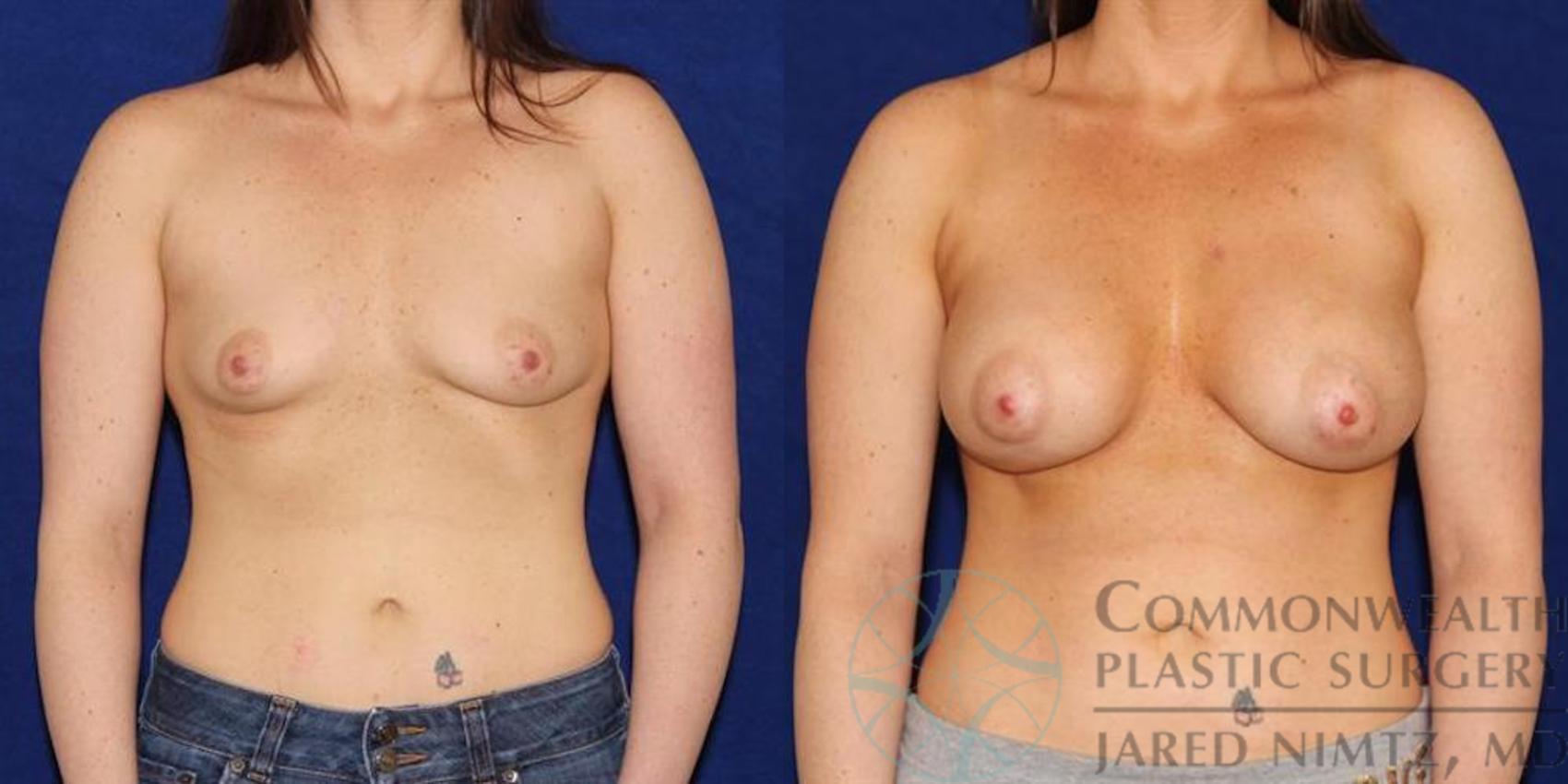Before & After Breast Augmentation Case 51 View #1 View in Lexington & London, KY