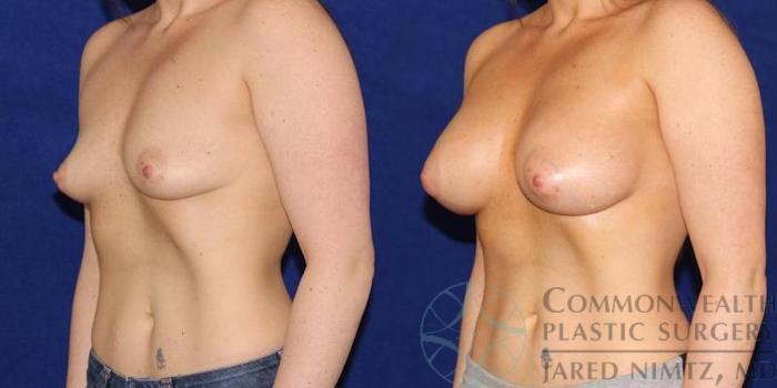 Before & After Breast Augmentation Case 51 View #2 View in Lexington & London, KY