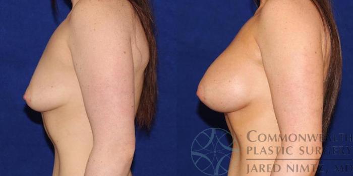 Before & After Breast Augmentation Case 51 View #3 View in Lexington & London, KY