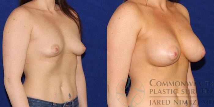 Before & After Breast Augmentation Case 51 View #4 View in Lexington & London, KY