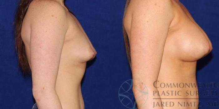 Before & After Breast Augmentation Case 51 View #5 View in Lexington & London, KY