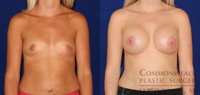 Before & After Breast Augmentation Case 63 View #1 View in Lexington & London, KY
