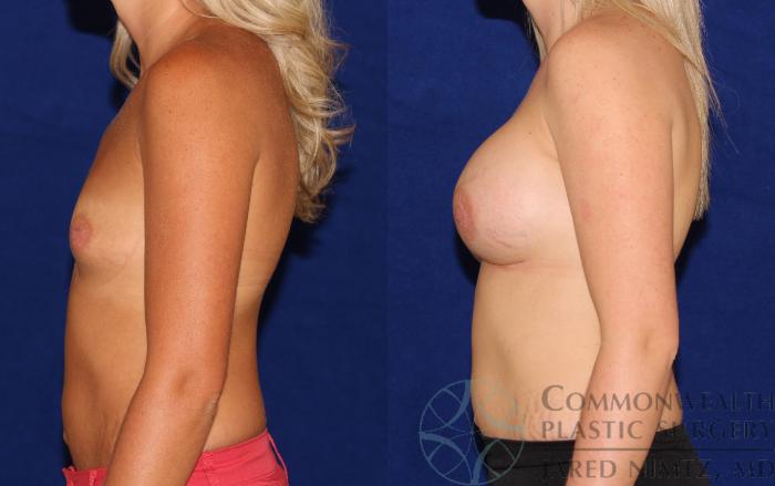 Before & After Breast Augmentation Case 63 View #3 View in Lexington & London, KY
