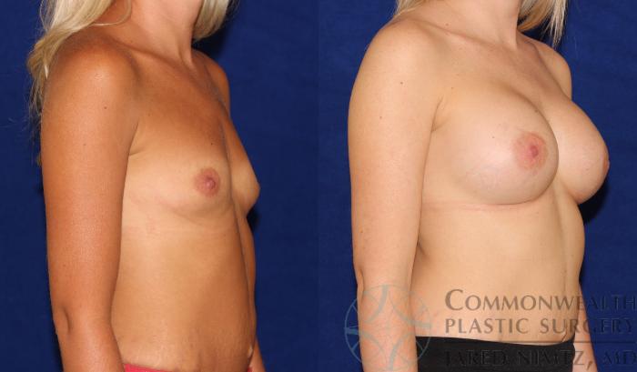Before & After Breast Augmentation Case 63 View #4 View in Lexington & London, KY