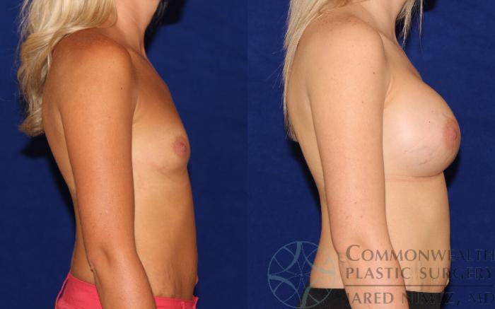 Before & After Breast Augmentation Case 63 View #5 View in Lexington & London, KY